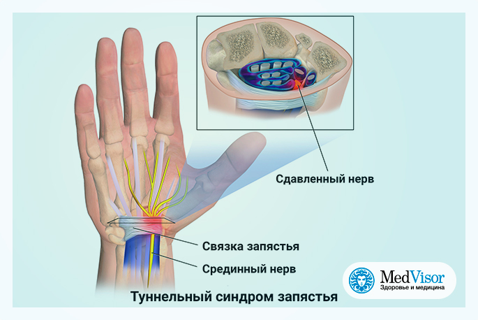 Почему немеют пальцы правой кисти. Туннельный синдром кисти руки. Карпальный синдром лучезапястного сустава. Карпальный туннельный синдром.